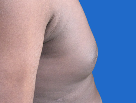 gynecomastie-apres.jpg