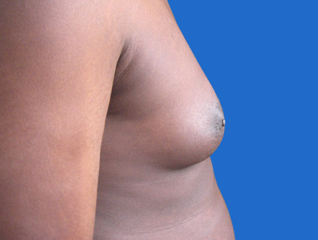 gynecomastie-avant.jpg